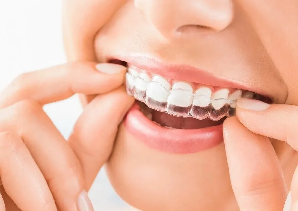 マウスピース矯正とは