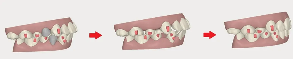 抜歯矯正によるEラインの改善