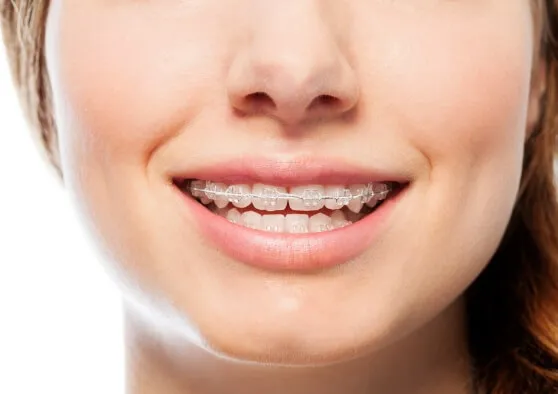 表側矯正の矯正費用