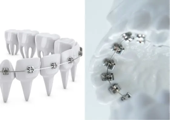 ハーフリンガル矯正の矯正費用