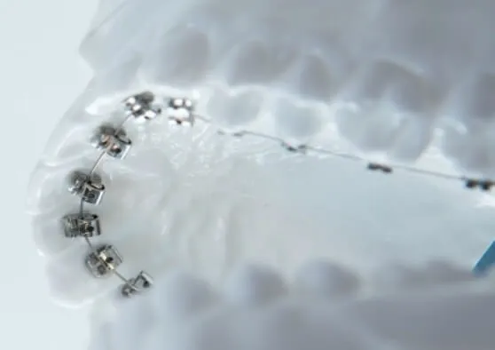 裏側の部分矯正(前歯のみ)