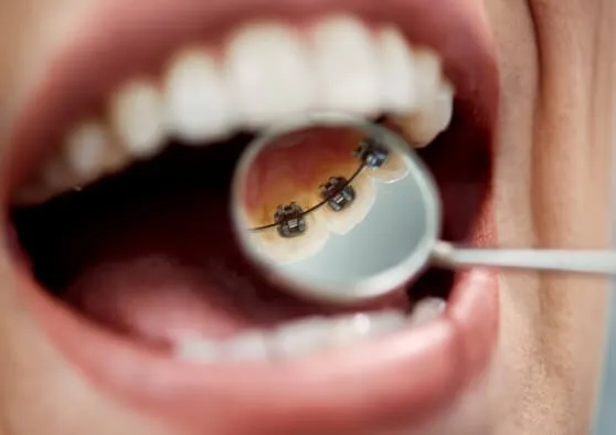 ハーフリンガルの部分矯正(前歯のみ)